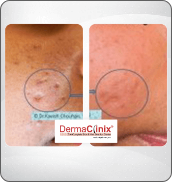 hair transplant results