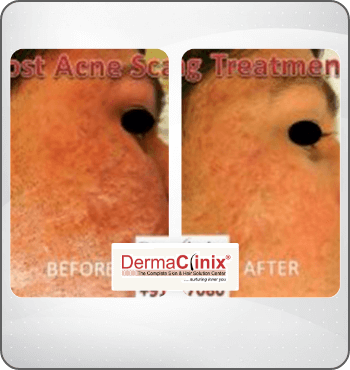 hair transplant results