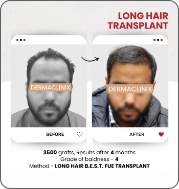 hair transplant results