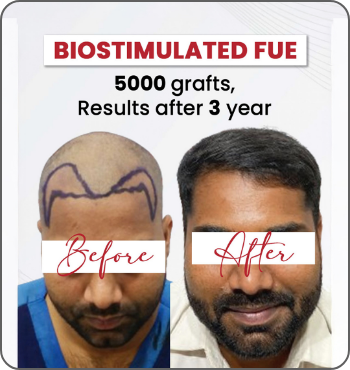 hair transplant results