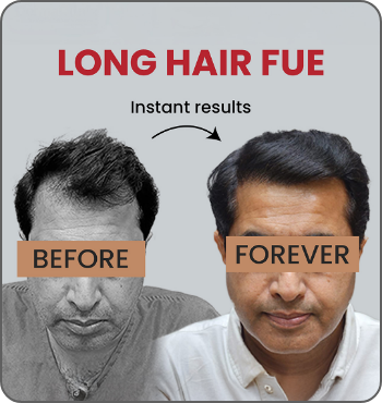 hair transplant results