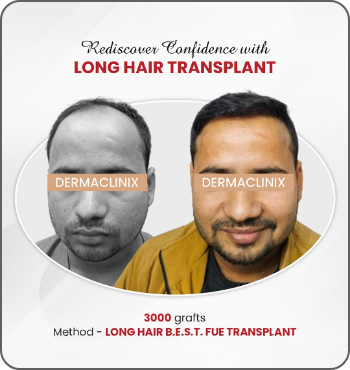 hair transplant results