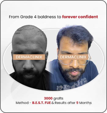 hair transplant results