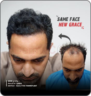 hair transplant results