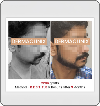 hair transplant results