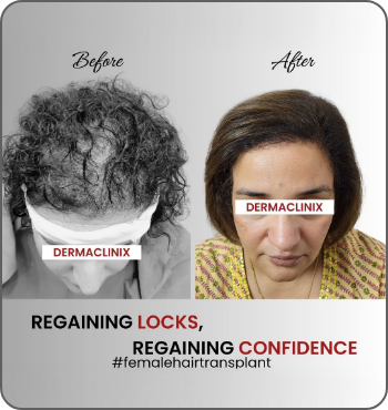 hair transplant results