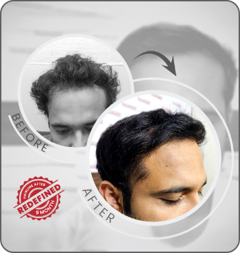 hair transplant results