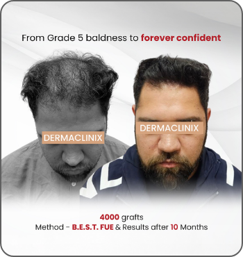 hair transplant results