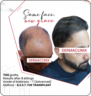 hair transplant results