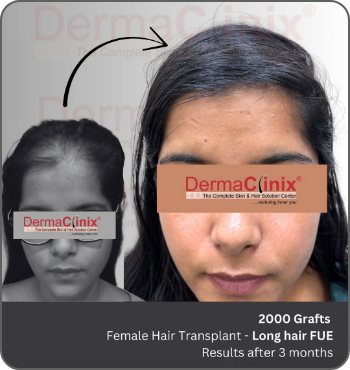 hair transplant results