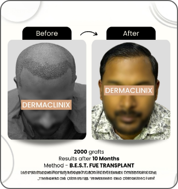 hair transplant results