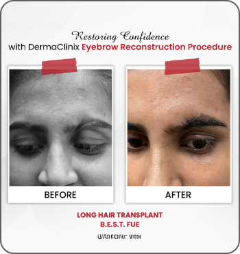 hair transplant results