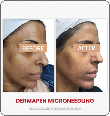 hair transplant results