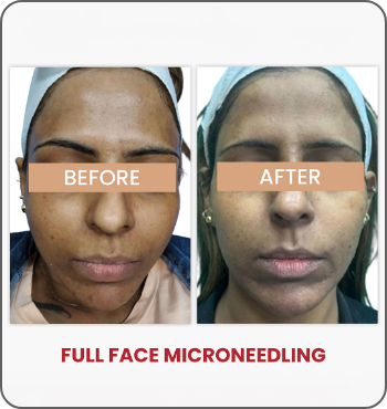 hair transplant results
