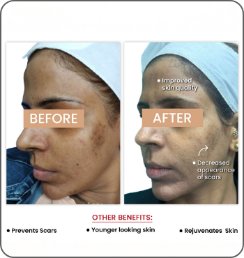 hair transplant results