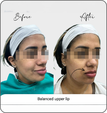 hair transplant results