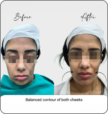 hair transplant results