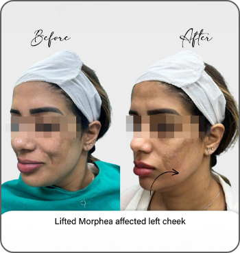 hair transplant results