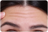 area-botox-section
